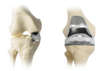 Операция по замене коленного сустава: описание процесса