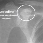 Что такое бурсит плечевого сустава и как его лечить