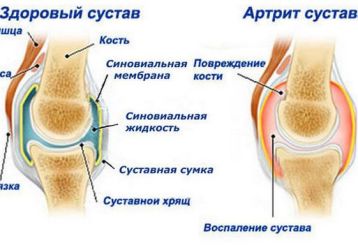 Болезни суставов: как называются, симптомы и лечение заболеваний