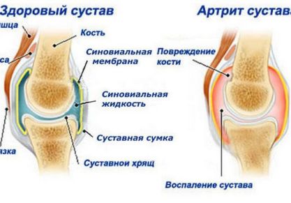 Болезни суставов: как называются, симптомы и лечение заболеваний