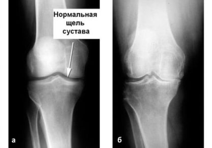 Артроз коленного сустава 3 степени: лечение, причины, симптомы