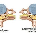 Что такое циркулярная протрузия диска: виды и стадии болезни, схемы лечения