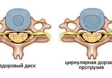 Что такое циркулярная протрузия диска: виды и стадии болезни, схемы лечения
