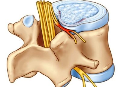 Что такое фораминальная грыжа межпозвонкового диска: симптомы, диагностика и лечение