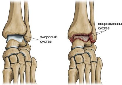 Артрит голеностопного сустава: симптомы и лечение, причины, виды, фото