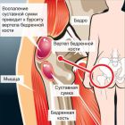 Воспаление тазобедренного сустава: симптомы и лечение