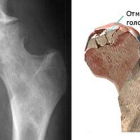 Асептический некроз головки бедренной кости: причины, симптомы, лечение