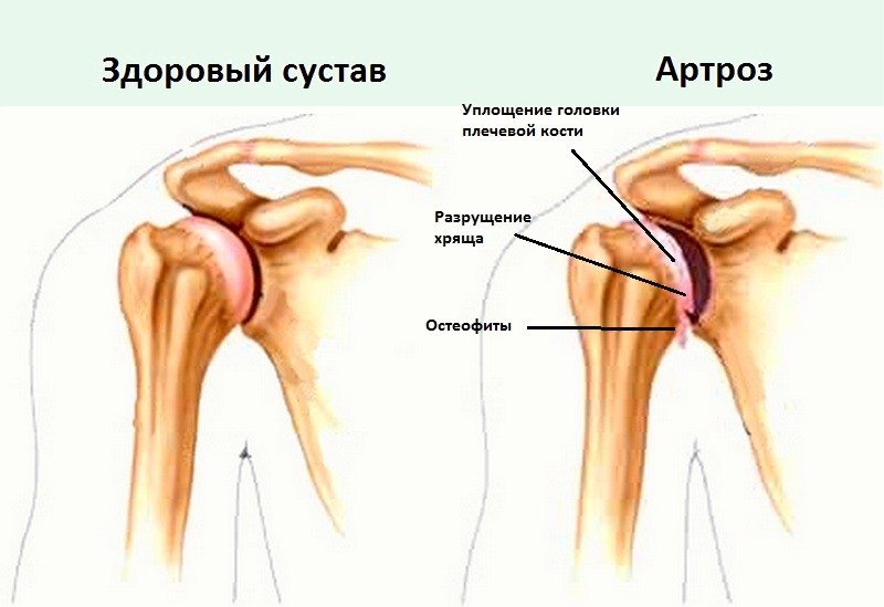 Изображение - Начальный артроз плечевого сустава artroz-plechevogo-sustava