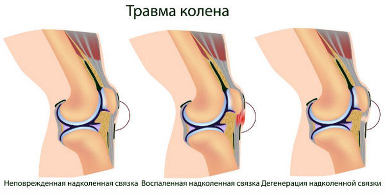 Травма колена