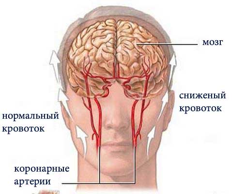 Мигрень и шейный остеохондроз симптомы