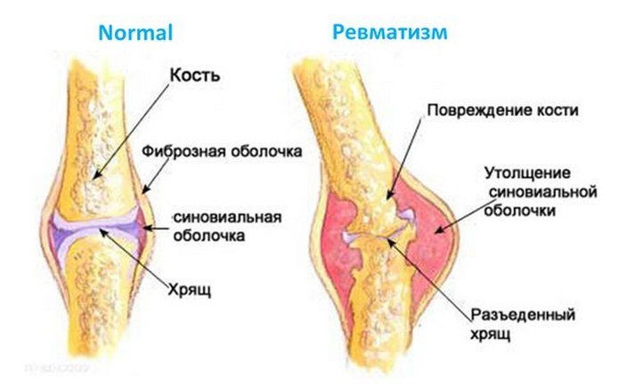 Ревматизм суставов симптомы лечение