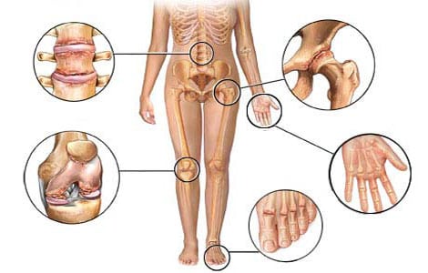 Изображение - Как проявляется артрит суставов artrit-16