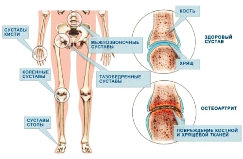 Изображение - Как проявляется артрит суставов artrit_lechenie