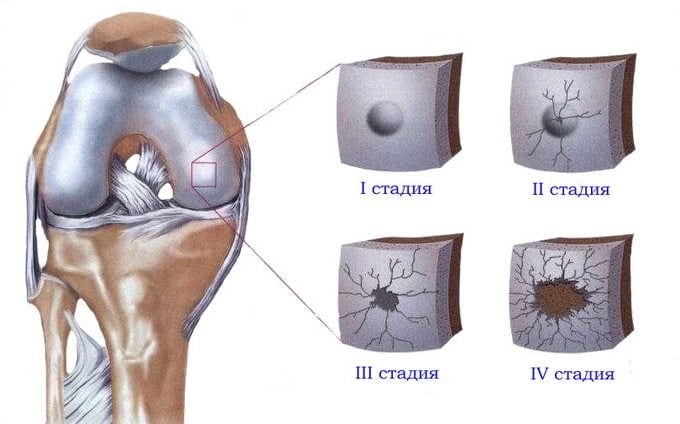 Чем отличается артрит и артроз коленного сустава симптомы и лечение