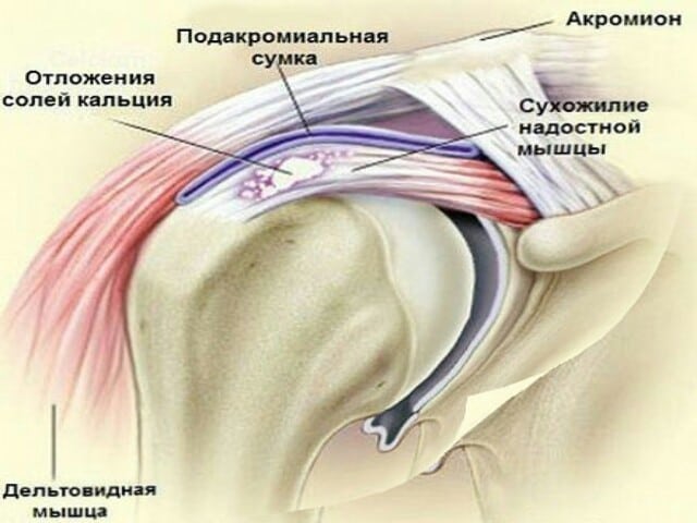 Воспаление суставов плечевого сустава