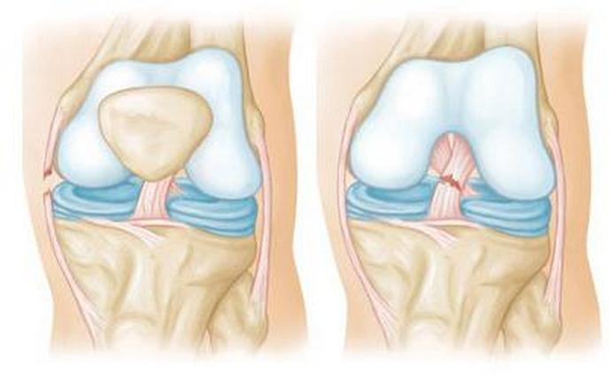 Разрыв связок колена