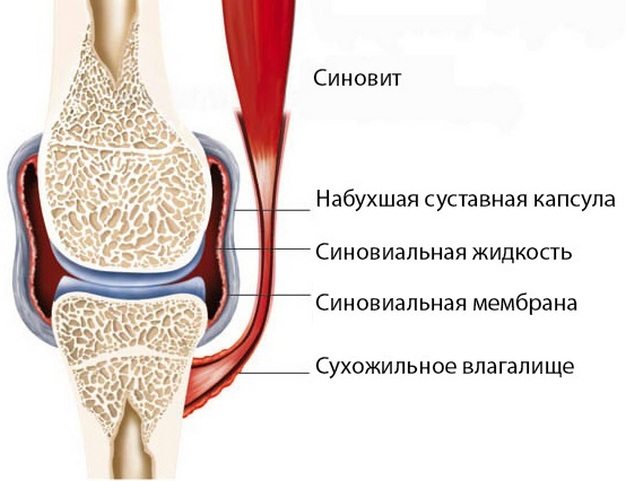 Что такое синовит коленного сустава
