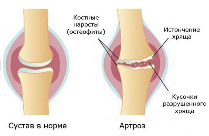 Изображение - Болят суставы кистей рук и ног lechenie-boli-v-sustavah-ruk-i-nog