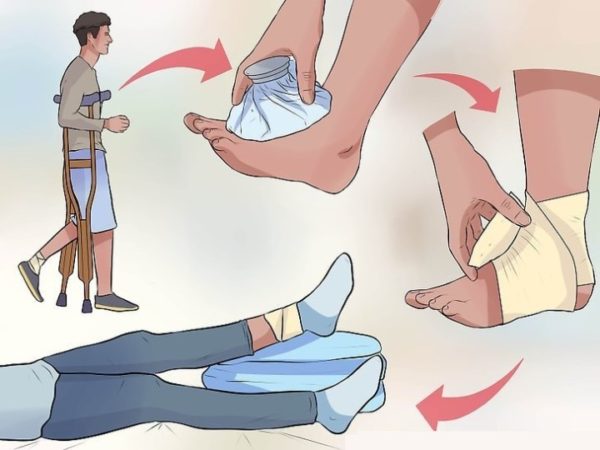 Как и чем лечить растяжение связок ноги вывих на щиколотке в домашних условиях