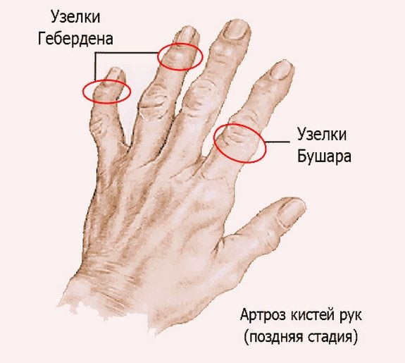Артроз суставов кисти руки лечение