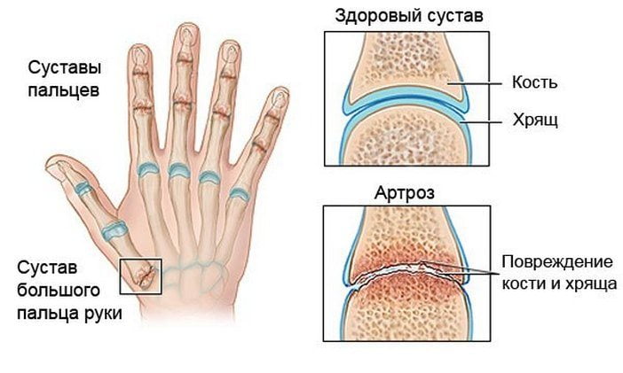 Артроз суставов кисти руки лечение