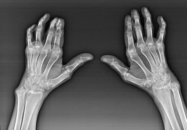 Рентген кистей рук 