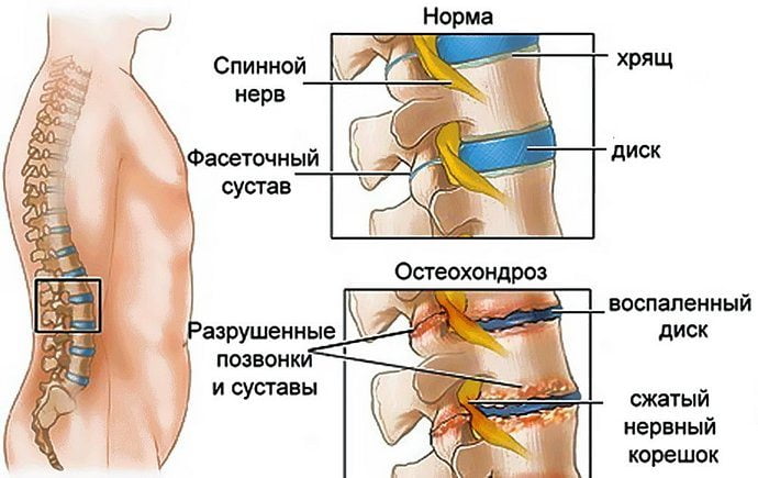 Инвалидность по остеохондрозу позвоночника