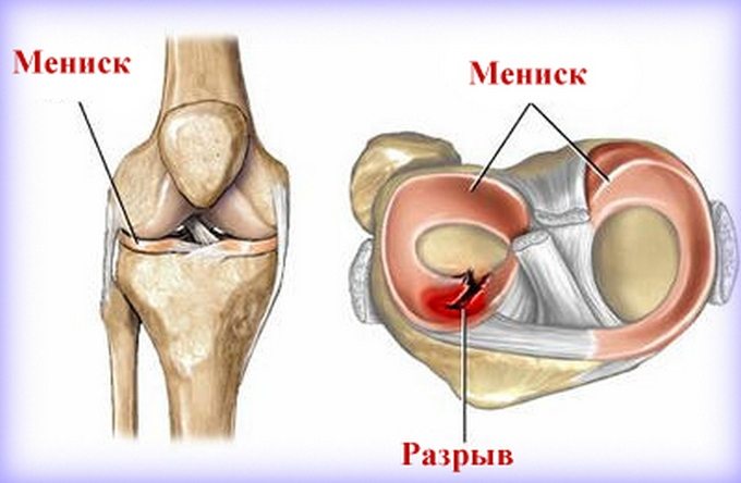 Изображение - Боль в коленном суставе при ходьбе лечение pri-hodbe-boli-v-kolenyah