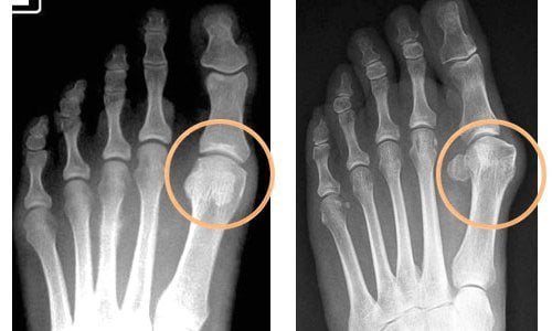 Артрит пальцев ног - симптомы, лечение, диета