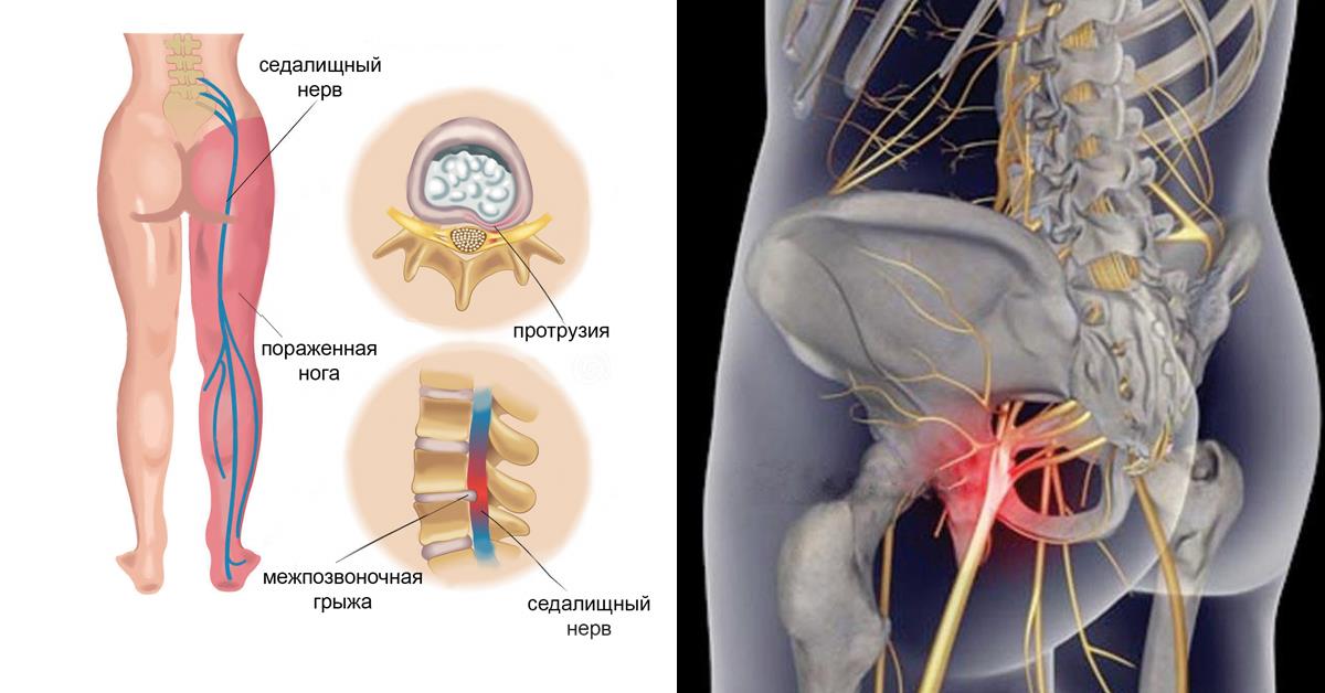 Что делать находиться. Люмбоишиалгия поясничного отдела позвоночника. Седалищный нерв. Ишиас - защемление седалищного нерва. Защемление седалищного нерва s1.