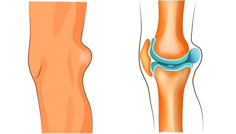 Киста Бехтерева в коленном суставе лечение