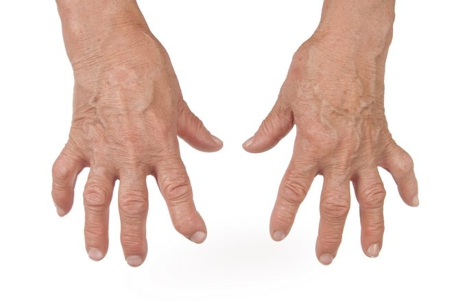 Артрит пальцев рук 