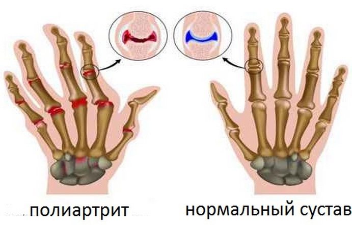 Полиартрит пальцев рук