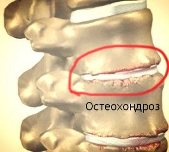 simptomy osteoxondroz grudnoj