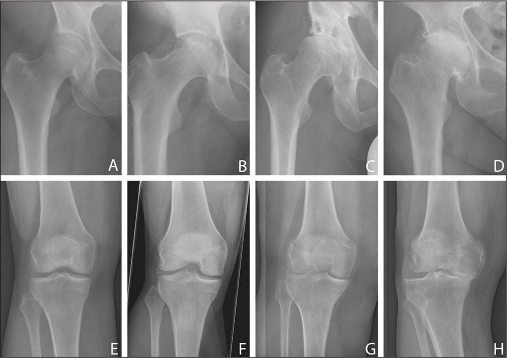 Характеристика остеоартроза коленного сустава 1 степени: причины, симптомы и лечение