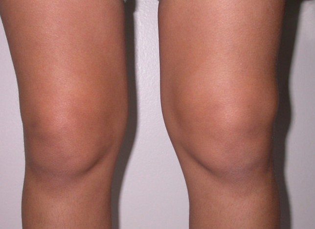 Изображение - Болят связки коленного сустава с внешней стороны bolit-koleno-pri-sgibanii-s-vneshnej-storony