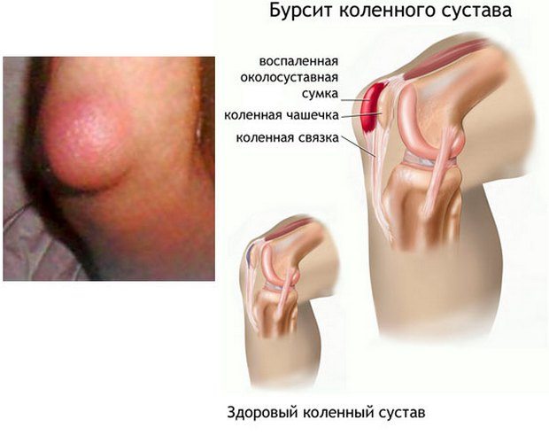 Изображение - Болят связки коленного сустава с внешней стороны bolit-koleno-s-vneshnej-storony