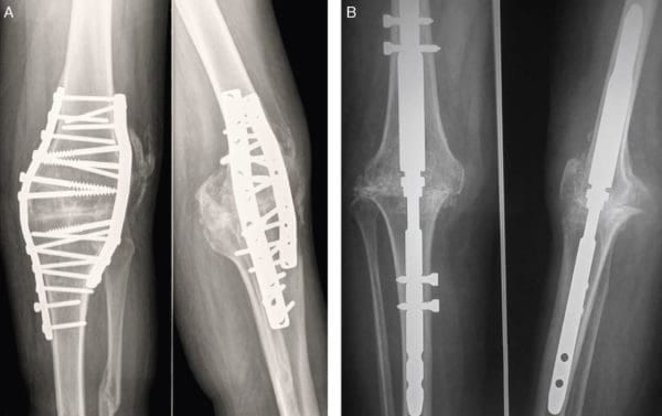 Изображение - Как лечится гонартроз коленного сустава gonartroz-3-i-4-stepeni-kolennogo-sustava-lechenie-i-priznaki-14