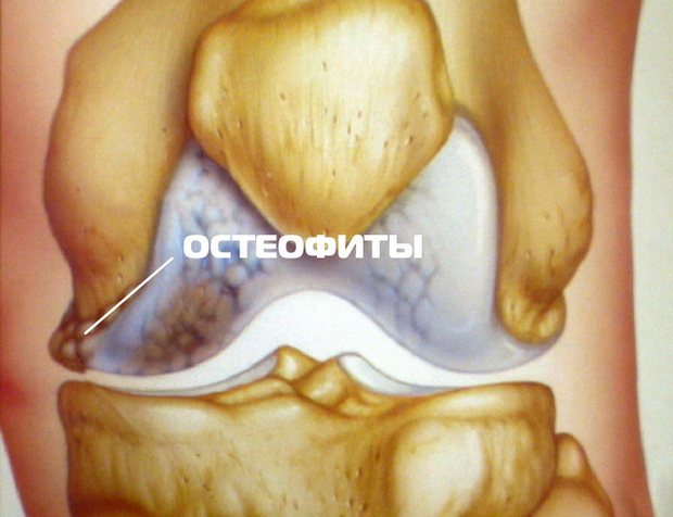 Остеофиты на колене 