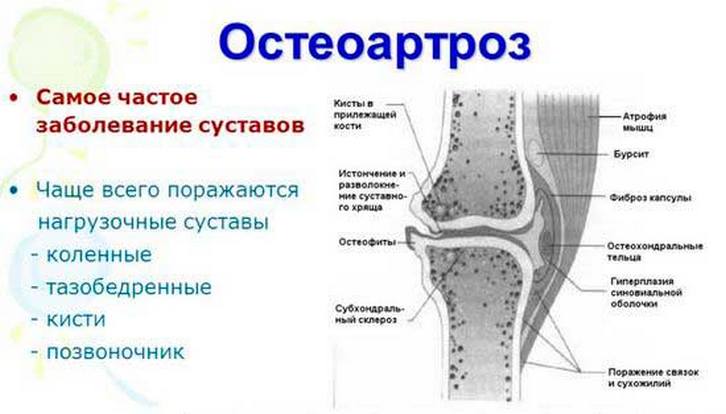 Остеоартроз 