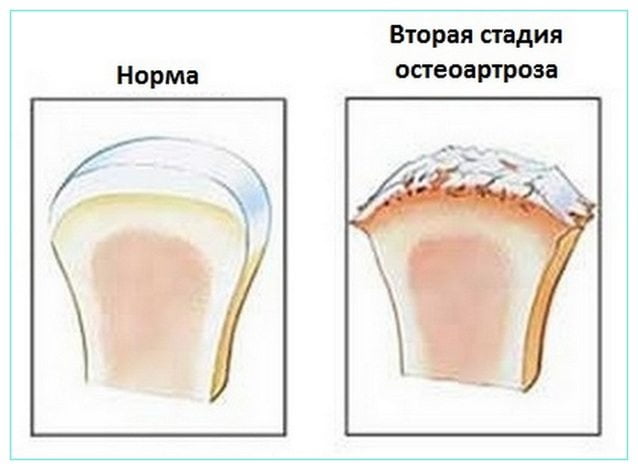 Остеоартроз коленного сустава 2 степени