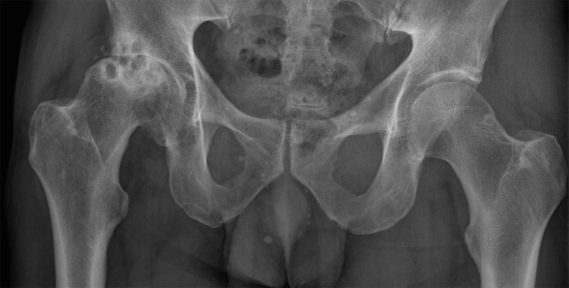 Изображение - Как проявляется коксартроз тазобедренного сустава rentgen-koksartroz