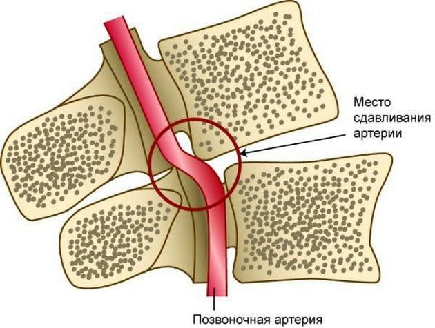 sindrom pozvonochnoj arterii pri shejnom osteoxondroze lechenie