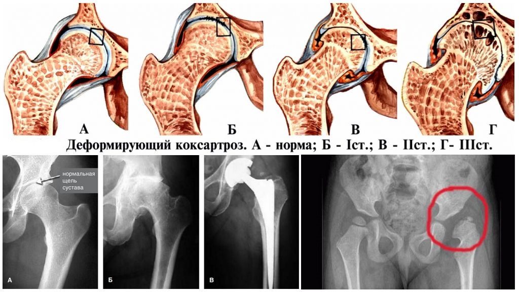 Изображение - Какие симптомы при коксартрозе тазобедренного сустава stadii-koksartroza