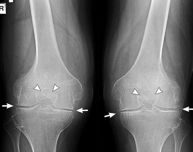 Гонартроз коленного сустава 2 степени: лечение медикаментозное и народными средствами. Диета и гимнастика при гонартрозе коленного сустава 2 степени