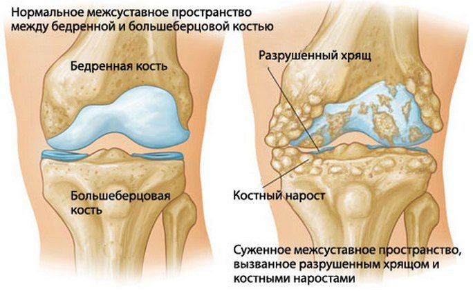 Артроз колена
