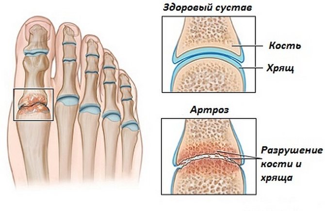 Изображение - Артроз суставов правой стопы artroz-stopy