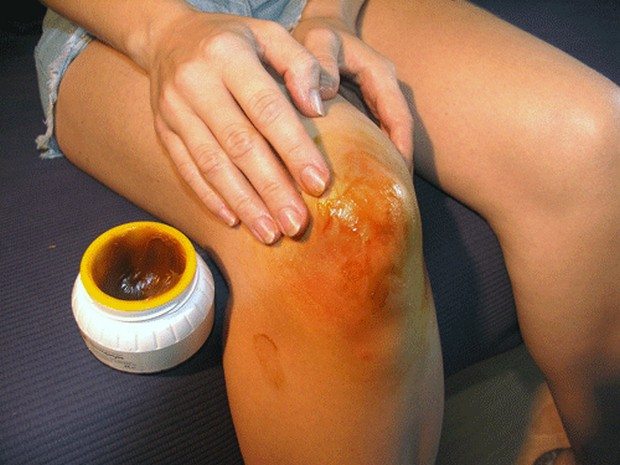 Изображение - Артроз коленного сустава лечение медом chem-lechit-artroz-kolennogo-sustava-v-domashnix-usloviyax