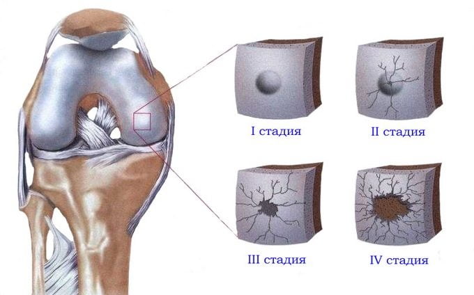 Стадии артроза колена