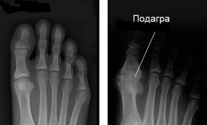 Подагра на рентгене 